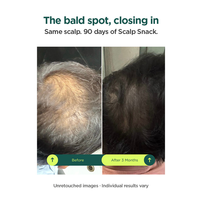 Scalp Snack